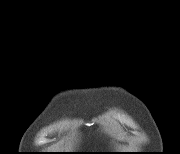 Adenocarcioma of rectum- T1 lesion (Radiopaedia 36921-38547 Coronal C+ arterial phase 4).png