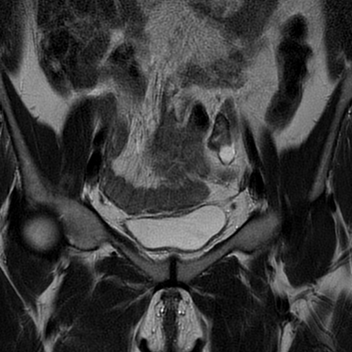 File:Adenomyosis-scar endometriosis (Radiopaedia 65863-75022 Coronal T2 10).jpg