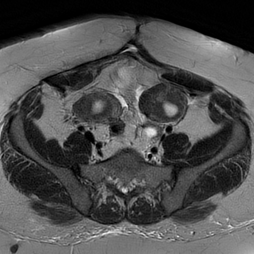 File:Adenomyosis within a didelphys uterus (Radiopaedia 70175-80215 Axial T2 10).jpg