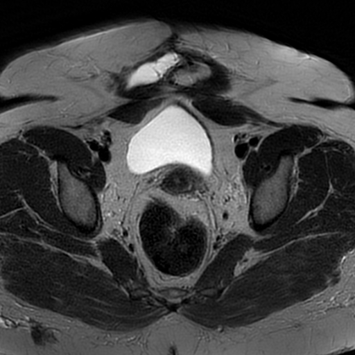 File:Adenomyosis within a didelphys uterus (Radiopaedia 70175-80215 Axial T2 21).jpg