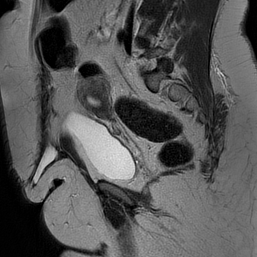 File:Adenomyosis within a didelphys uterus (Radiopaedia 70175-80215 Sagittal T2 14).jpg