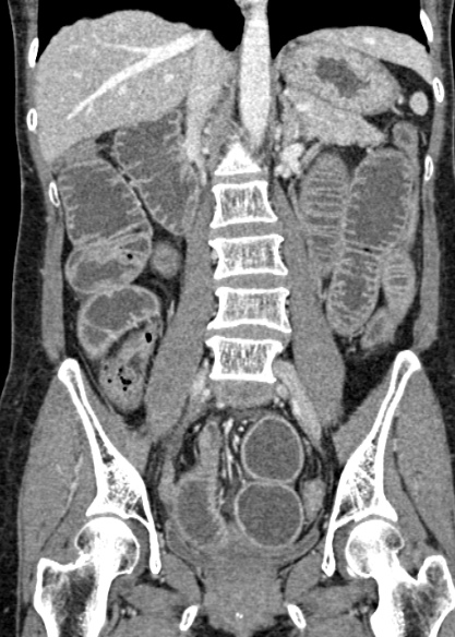 Adhesional small bowel obstruction (Radiopaedia 48397-53305 Coronal C+ portal venous phase 201).jpg
