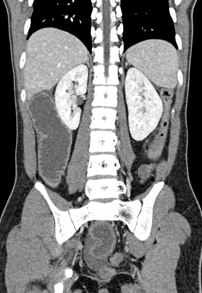 Adhesional small bowel obstruction (Radiopaedia 52107-57980 Coronal C+ portal venous phase 58).jpg
