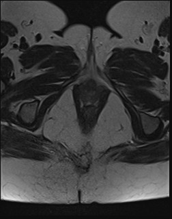 File:Adnexal multilocular cyst (O-RADS US 3- O-RADS MRI 3) (Radiopaedia 87426-103754 Axial T2 26).jpg