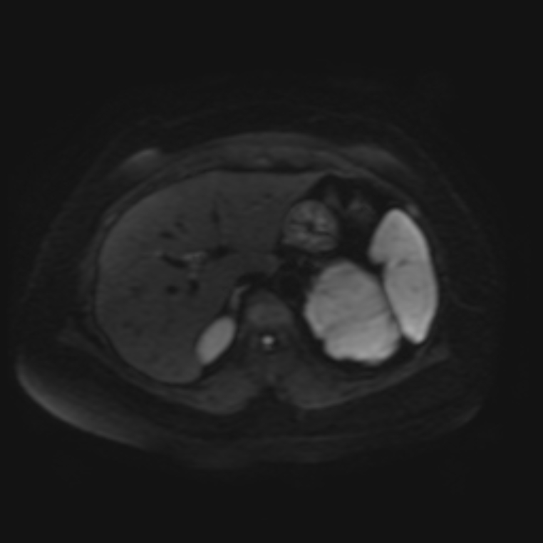 Adrenal cortical carcinoma (Radiopaedia 70906-81116 Axial DWI 8).jpg