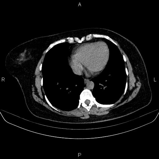 File:Adrenal cortical carcinoma (Radiopaedia 84882-100379 Axial non-contrast 3).jpg