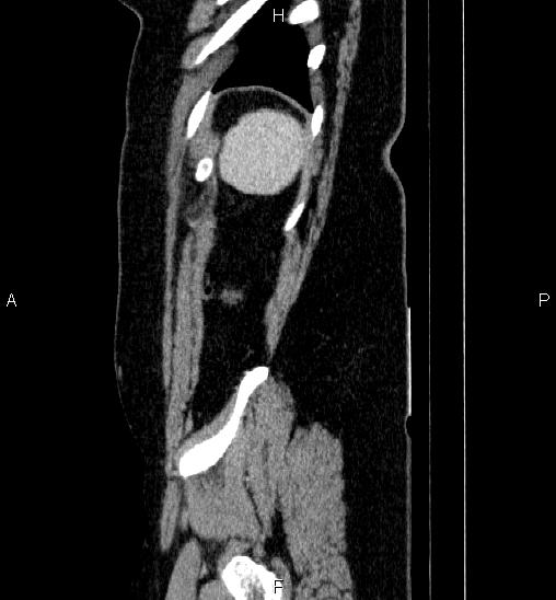 Adrenal cortical carcinoma (Radiopaedia 84882-100379 Sagittal C+ portal venous phase 80).jpg