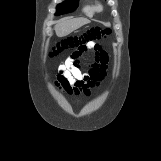 Adrenal cyst (Radiopaedia 45625-49776 Coronal C+ portal venous phase 16).png