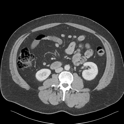 File:Adrenal cyst (Radiopaedia 45625-49777 Axial C+ portal venous phase 53).png