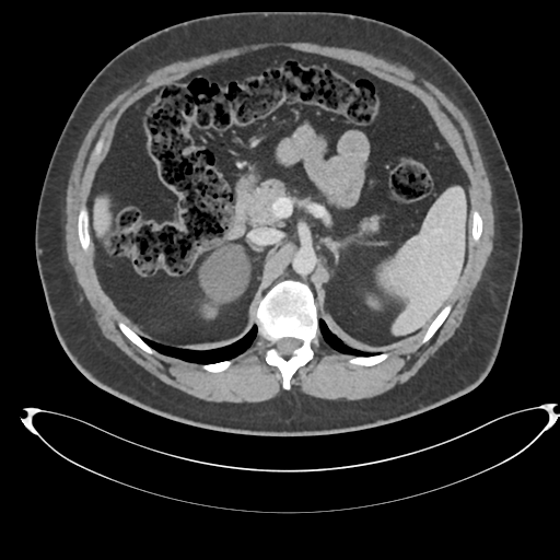File:Adrenal cyst (Radiopaedia 45625-49778 AXIAL THICK 60 sec 24).png