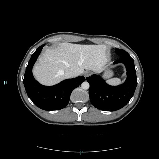 File:Adrenal cystic lymphangioma (Radiopaedia 83161-97534 Axial C+ portal venous phase 15).jpg