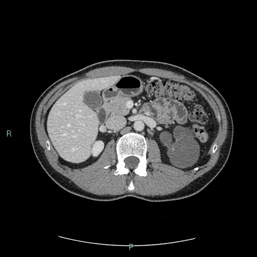 Adrenal cystic lymphangioma (Radiopaedia 83161-97534 Axial C+ portal venous phase 35).jpg