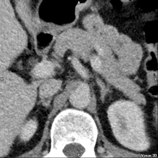 File:Adrenal glands (normal CT anatomy) (Radiopaedia 16570-105725 Axial 5).jpg