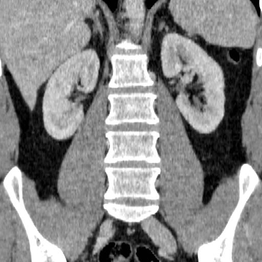 File:Adrenal glands (normal CT anatomy) (Radiopaedia 16570-105725 Coronal 11).jpg