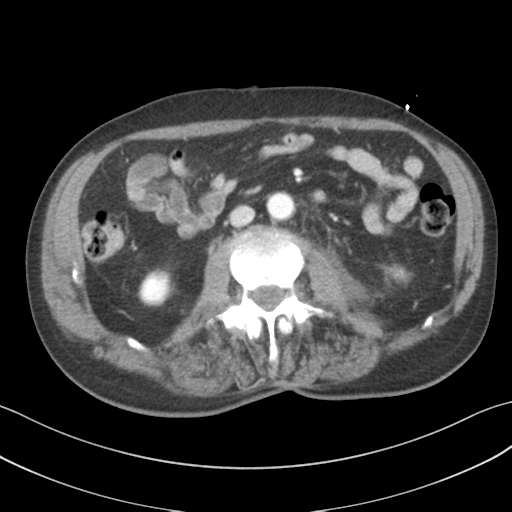 File:Adrenal hematoma (Radiopaedia 44334-47968 Axial C+ portal venous phase 39).png