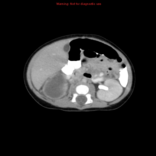 File:Adrenal hemorrhage (Radiopaedia 9390-10077 Axial C+ portal venous phase 13).jpg