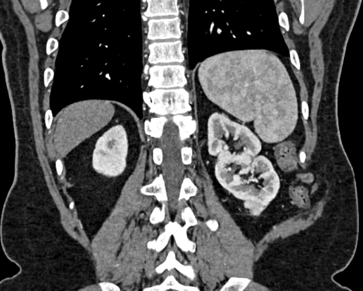 File:Adrenal metastases (Radiopaedia 73082-83791 Coronal C+ arterial phase 63).jpg