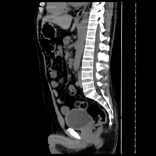 File:Adrenal myelolipoma (Radiopaedia 41843-44834 Sagittal non-contrast 23).jpg