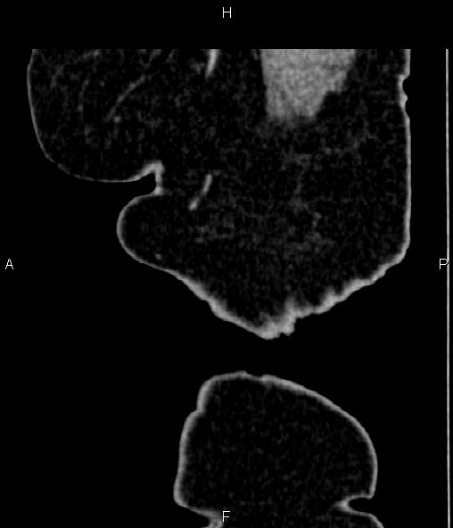 Adrenal myelolipoma (Radiopaedia 82742-96986 Sagittal renal cortical phase 6).jpg
