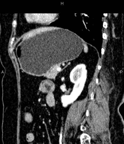 Adrenal myelolipoma (Radiopaedia 82742-96986 Sagittal renal cortical phase 71).jpg
