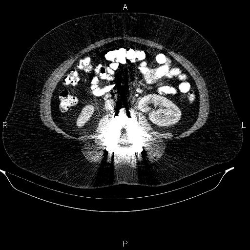 Adrenal myelolipoma (Radiopaedia 84319-99617 Axial renal cortical phase 61).jpg