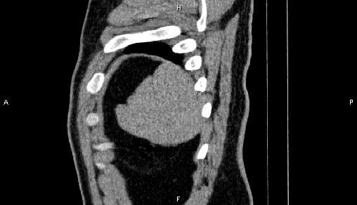 Adrenal myelolipoma (Radiopaedia 84321-99619 Sagittal non-contrast 101).jpg