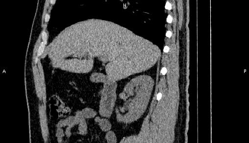 Adrenal myelolipoma (Radiopaedia 84321-99619 Sagittal non-contrast 36).jpg