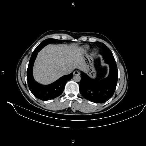 Adrenal myelolipoma (Radiopaedia 87794-104246 Axial non-contrast 15).jpg
