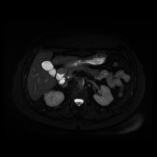 File:Adrenal myelolipoma - MRI (Radiopaedia 83249-97646 Axial STIR 18).jpg