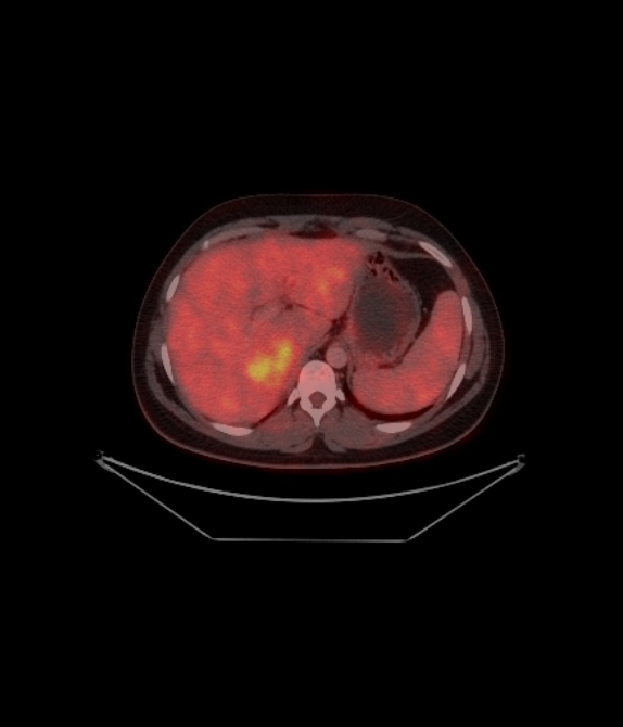 Adrenocortical carcinoma (Radiopaedia 80134-93440 ِAxial 150).jpg