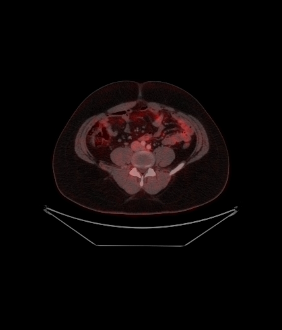 Adrenocortical carcinoma (Radiopaedia 80134-93440 ِAxial 205).jpg