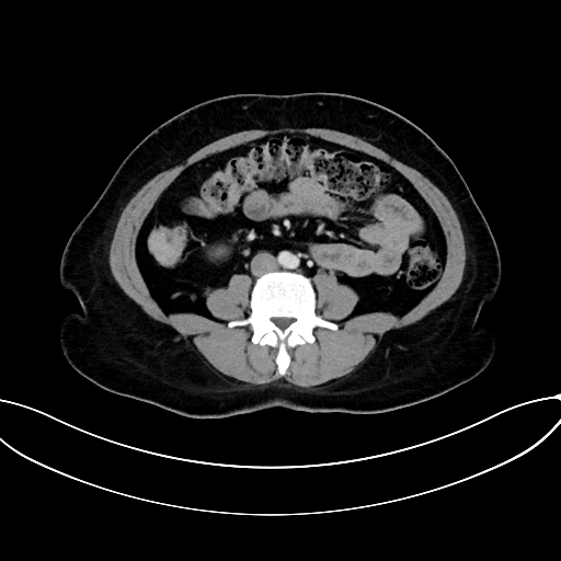 Adrenocortical carcinoma (Radiopaedia 87281-103569 Axial C+ portal venous phase 51).jpg