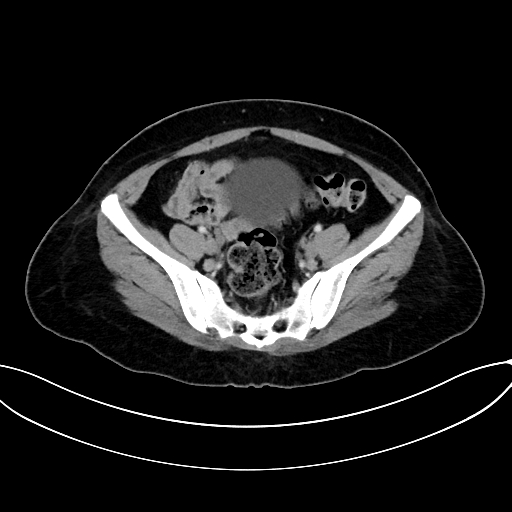 Adrenocortical carcinoma (Radiopaedia 87281-103569 Axial C+ portal venous phase 68).jpg