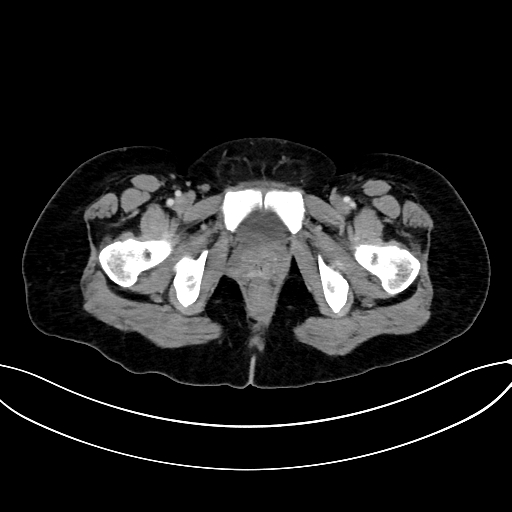 Adrenocortical carcinoma (Radiopaedia 87281-103569 Axial C+ portal venous phase 88).jpg