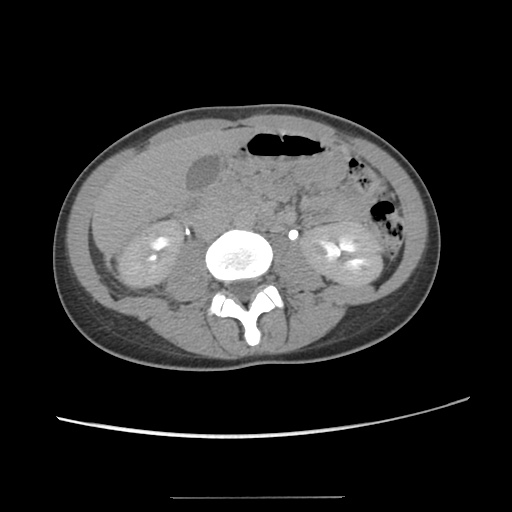 File:Adult polycystic kidney disease (Radiopaedia 48845-53876 Axial renal excretory phase 48).jpg