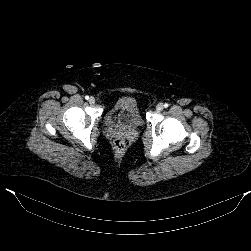 Afferent loop syndrome - secondary to incarcerated trocar site hernia (Radiopaedia 82959-97305 Axial C+ portal venous phase 227).jpg