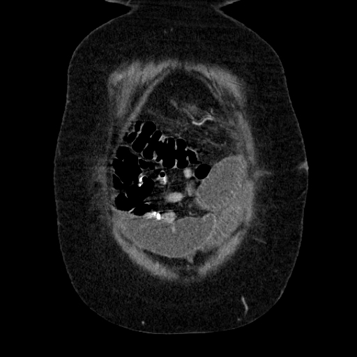 File:Afferent loop syndrome - secondary to incarcerated trocar site hernia (Radiopaedia 82959-97305 Coronal C+ portal venous phase 33).jpg