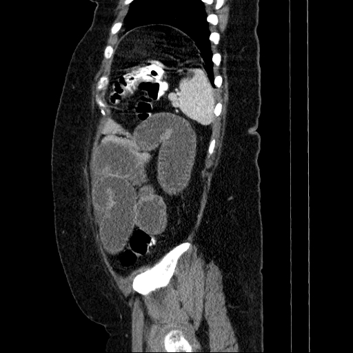 Afferent loop syndrome - secondary to incarcerated trocar site hernia (Radiopaedia 82959-97305 Sagittal C+ portal venous phase 27).jpg