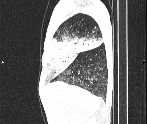 Air bronchogram in pneumonia (Radiopaedia 85719-101512 Sagittal lung window 22).jpg