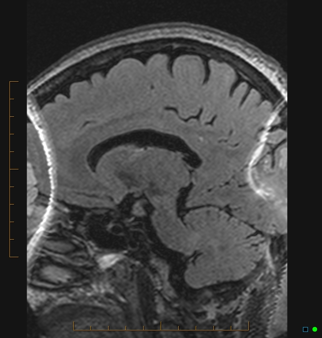 Aliasing artifact causing a spurious cerebellar lesion (Radiopaedia 48783-53810 Sagittal FLAIR 25).jpg