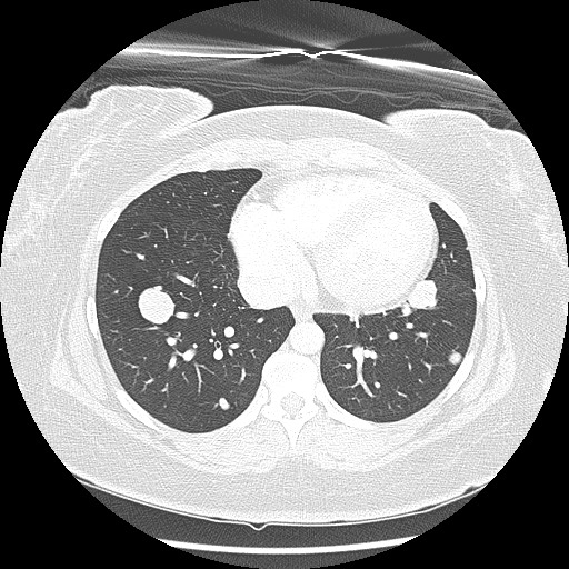 Alveolar soft part sarcoma - right leg (Radiopaedia 59432-67091 Axial lung window 79).jpg