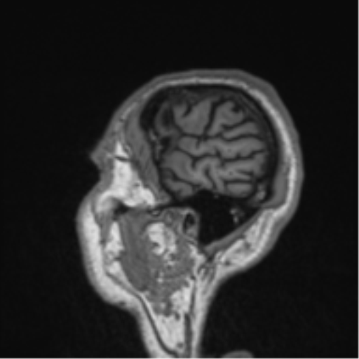Alzheimer's disease- with Gerstmann syndrome and dressing apraxia (Radiopaedia 54882-61150 Sagittal T1 5).png