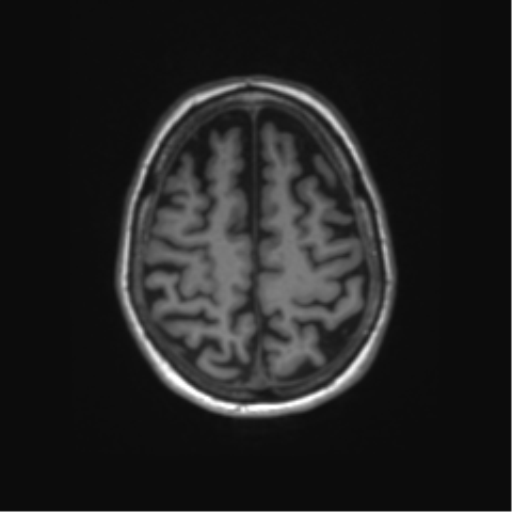 File:Alzheimer's disease (Radiopaedia 42658-45802 Axial T1 39).png