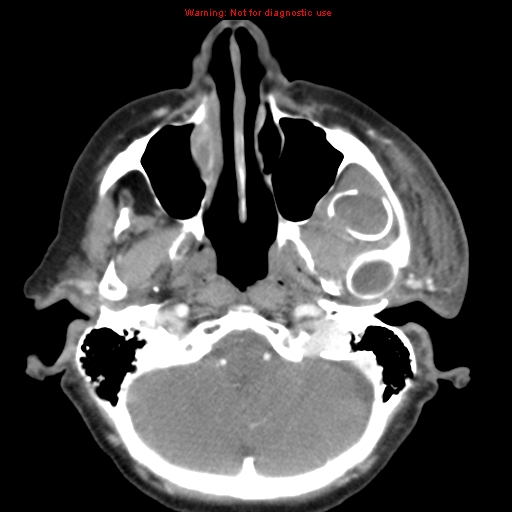Ameloblastoma (Radiopaedia 27437-27631 A 15).jpg