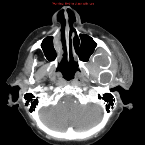 Ameloblastoma (Radiopaedia 27437-27631 A 17).jpg