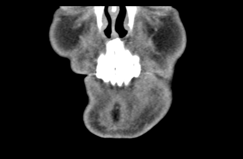 Ameloblastoma (Radiopaedia 33677-34806 Coronal non-contrast 13).png