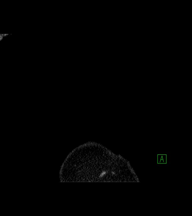 Amiodarone deposition in the liver (Radiopaedia 77587-89780 Coronal non-contrast 4).jpg