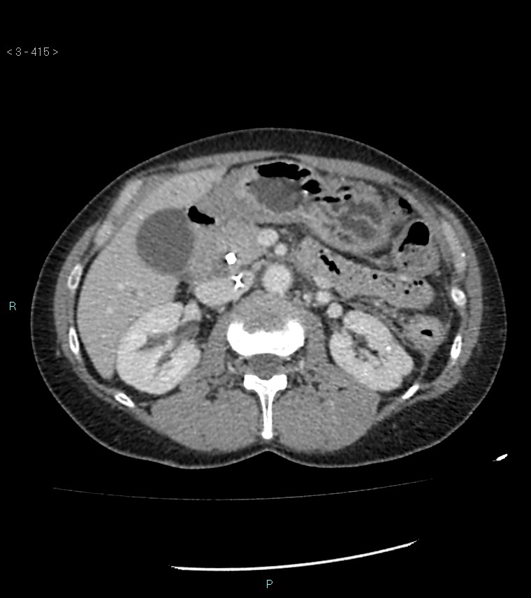 Ampulla of Vater metastasis (Radiopaedia 27820-28069 A 53).jpg