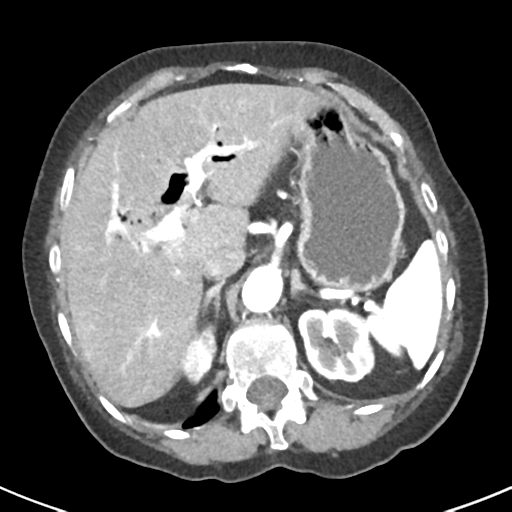 Ampullary adenocarcinoma (Radiopaedia 34013-35237 B 19).png