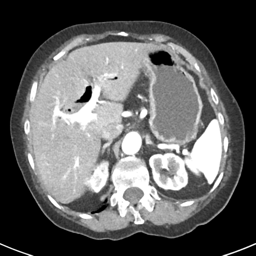 Ampullary adenocarcinoma (Radiopaedia 34013-35237 B 20).png